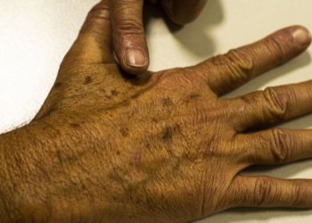 Tecnologia para tratar câncer de pele é aprovado para uso no SUS