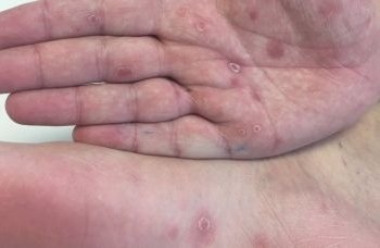 Feira de Santana tem redução em casos de sífilis