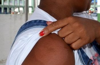 Feira de Santana tem redução de 7% nos casos de hanseníase
